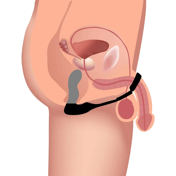 10X Inflatable and Vibrating Prostate Plug with Cock and Ball Ring Swell Male Sex Toys